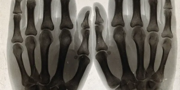 X-ray radiograph of both hands