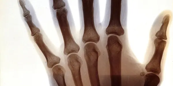 X-ray radiograph of a hand