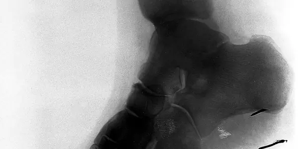 X-ray radiograph of an ankle and foot
